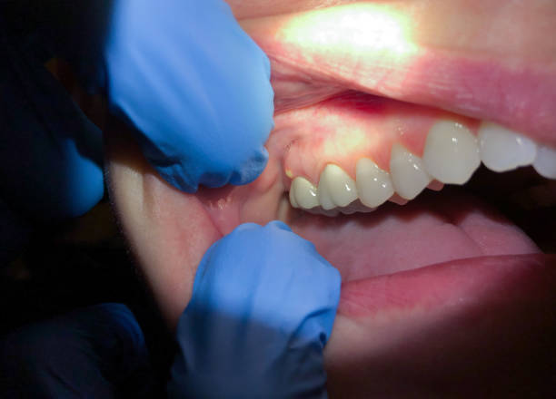 Best Emergency Treatment for Dental Infections or Abscesses in Homestead Valley, CA